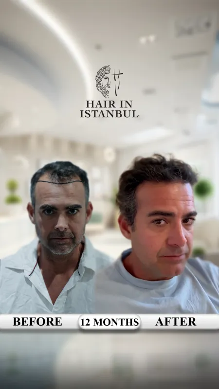 Hair transplant before and after · Hair in Istanbul, Istanbul