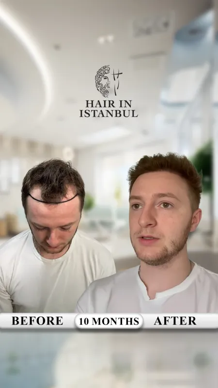 Hair transplant before and after · Hair in Istanbul, Istanbul