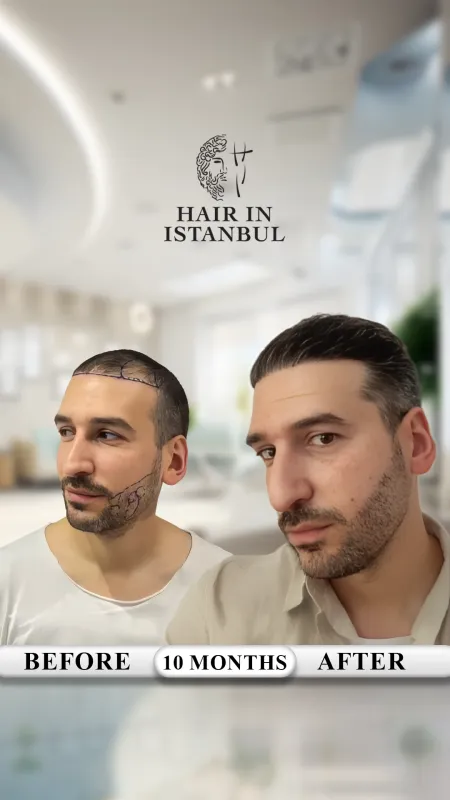 Hair transplant before and after · Hair in Istanbul, Istanbul