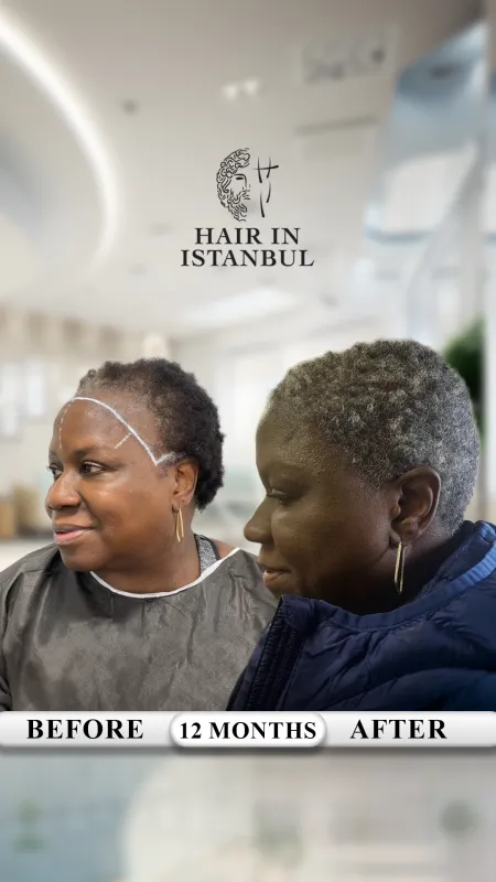 Hair transplant before and after · Hair in Istanbul, Istanbul
