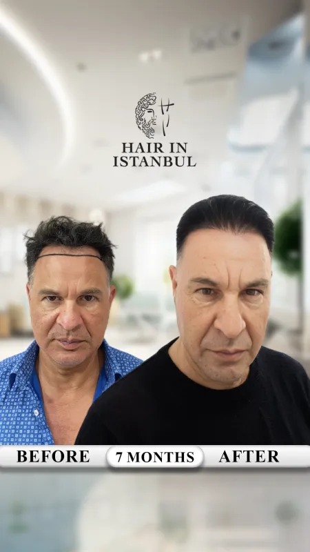 Hair transplant before and after · Hair in Istanbul, Istanbul