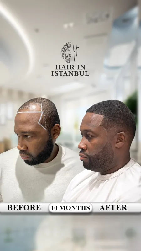 Hair transplant before and after · Hair in Istanbul, Istanbul