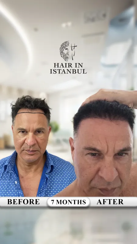 Hair transplant before and after · Hair in Istanbul, Istanbul