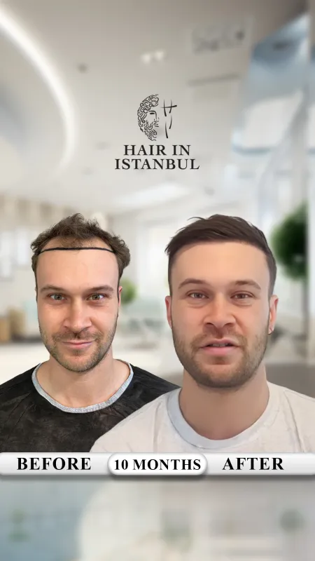 Hair transplant before and after · Hair in Istanbul, Istanbul
