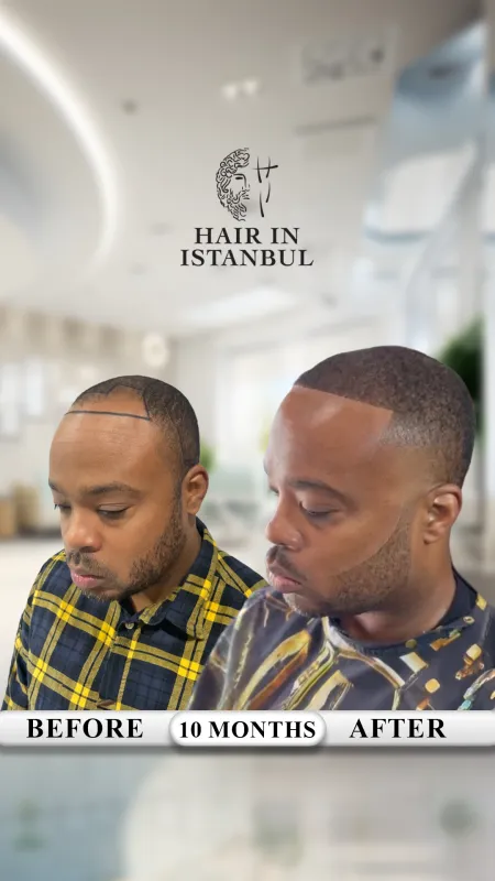 Hair transplant before and after · Hair in Istanbul, Istanbul