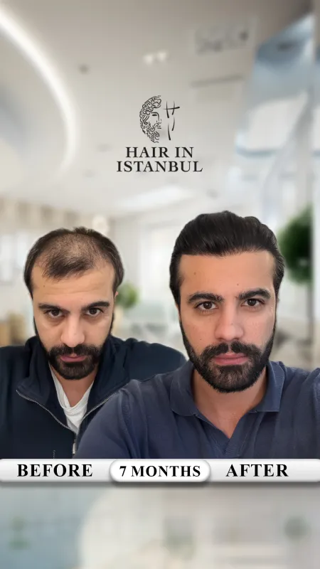 Hair transplant before and after · Hair in Istanbul, Istanbul