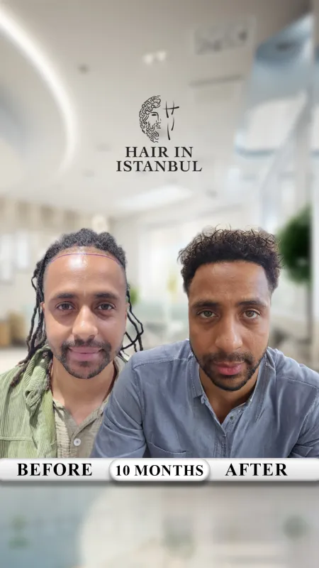 Hair transplant before and after · Hair in Istanbul, Istanbul