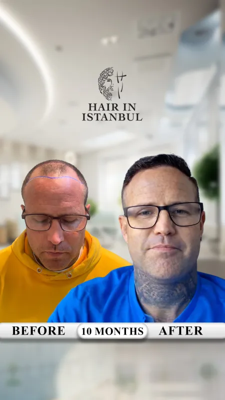 Hair transplant before and after · Hair in Istanbul, Istanbul