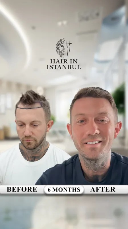 Hair transplant before and after · Hair in Istanbul, Istanbul