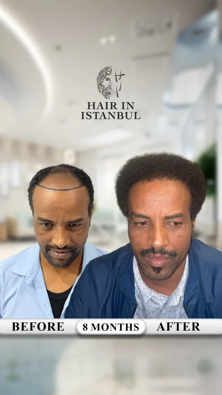 Hair transplant before and after · Hair in Istanbul, Istanbul
