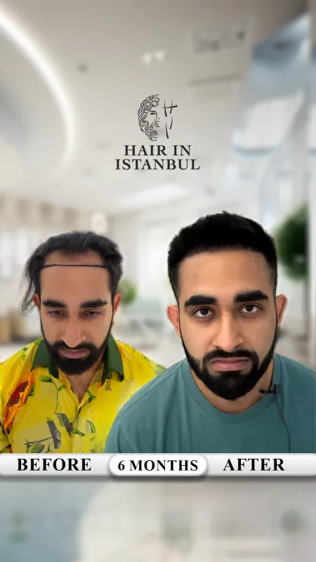 Hair transplant before and after · Hair in Istanbul, Istanbul