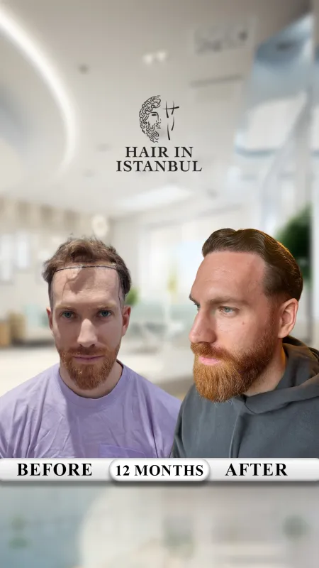 Hair transplant before and after · Hair in Istanbul, Istanbul