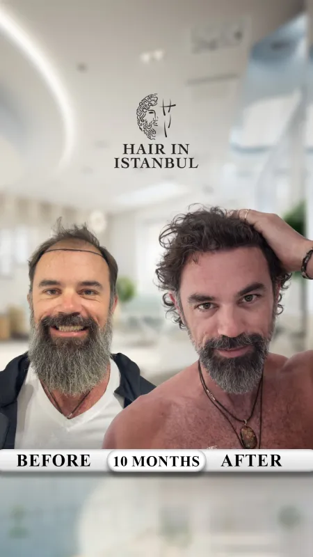 Hair transplant before and after · Hair in Istanbul, Istanbul