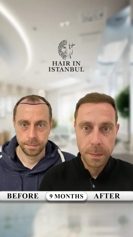 Hair transplant before and after · Hair in Istanbul, Istanbul