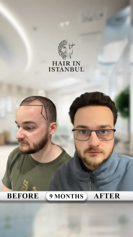 Hair transplant before and after · Hair in Istanbul, Istanbul