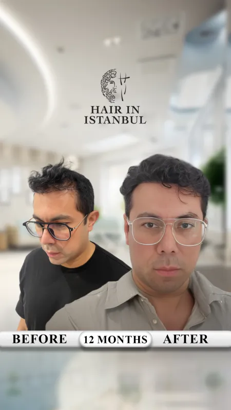 Hair transplant before and after · Hair in Istanbul, Istanbul