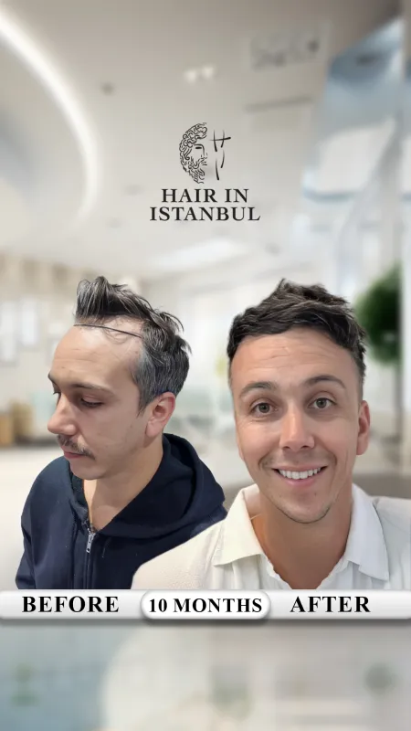 Hair transplant before and after · Hair in Istanbul, Istanbul