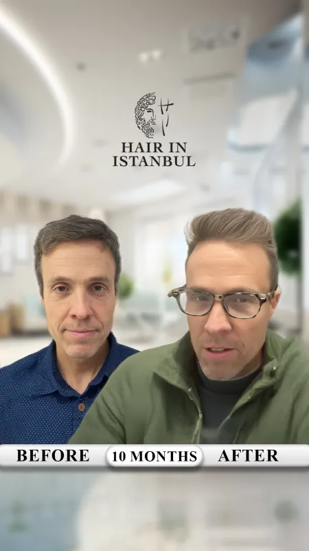 Hair transplant before and after · Hair in Istanbul, Istanbul
