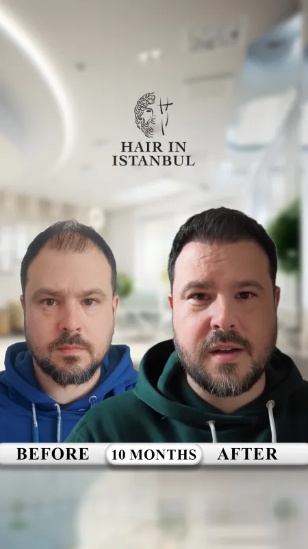 Hair transplant before and after · Hair in Istanbul, Istanbul