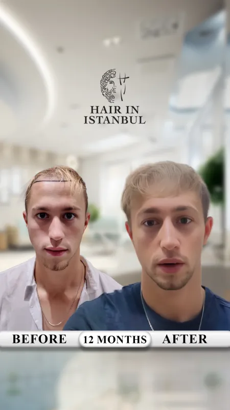 Hair transplant before and after · Hair in Istanbul, Istanbul
