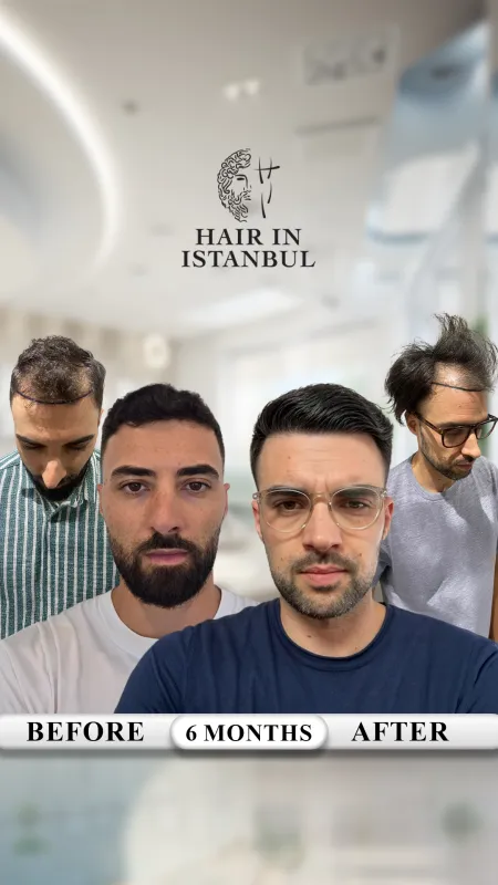 Hair transplant before and after · Hair in Istanbul, Istanbul