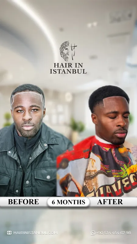 Hair transplant before and after · Hair in Istanbul, Istanbul