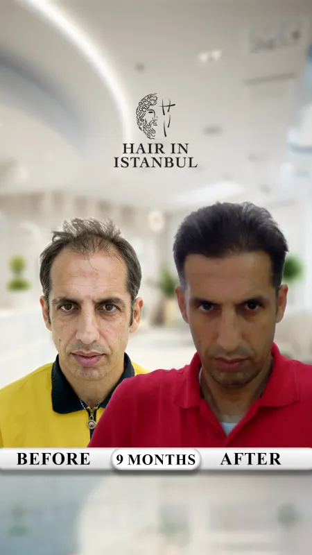 Hair transplant before and after · Hair in Istanbul, Istanbul