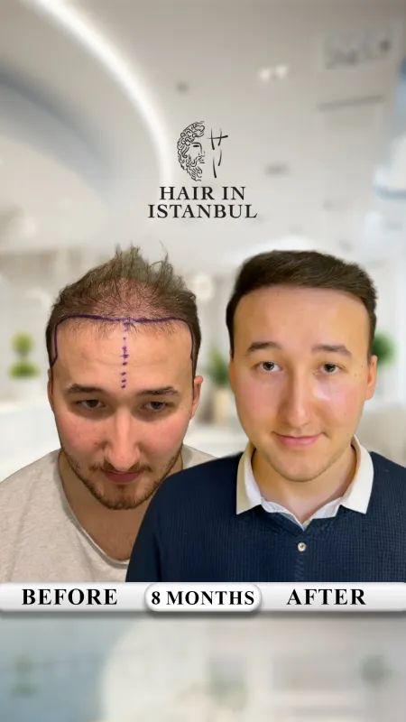 Hair transplant before and after · Hair in Istanbul, Istanbul