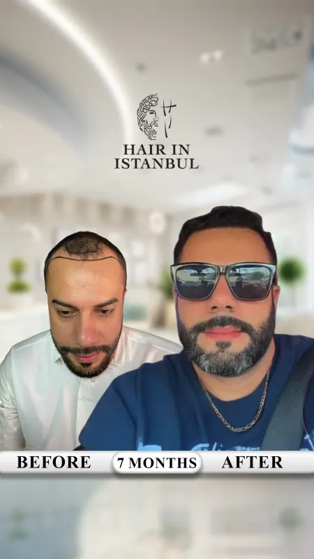 Hair transplant before and after · Hair in Istanbul, Istanbul