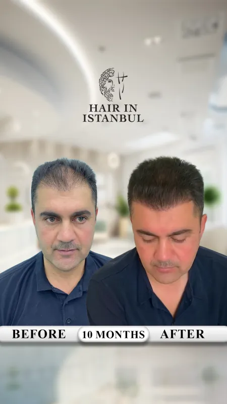 Hair transplant before and after · Hair in Istanbul, Istanbul