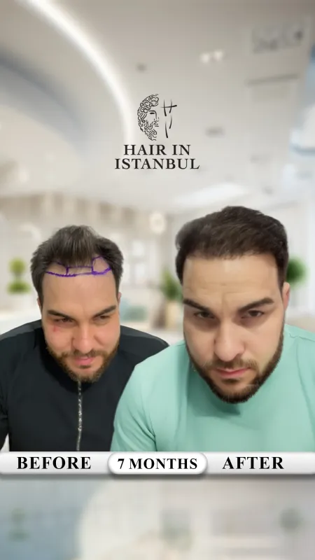 Hair transplant before and after · Hair in Istanbul, Istanbul