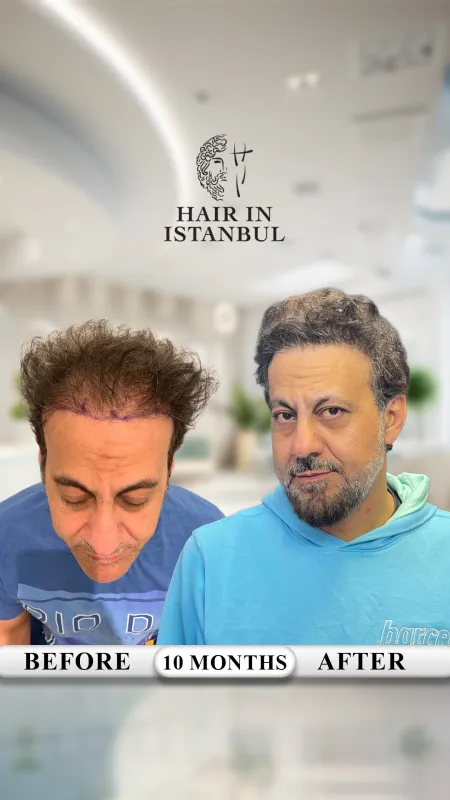 Hair transplant before and after · Hair in Istanbul, Istanbul