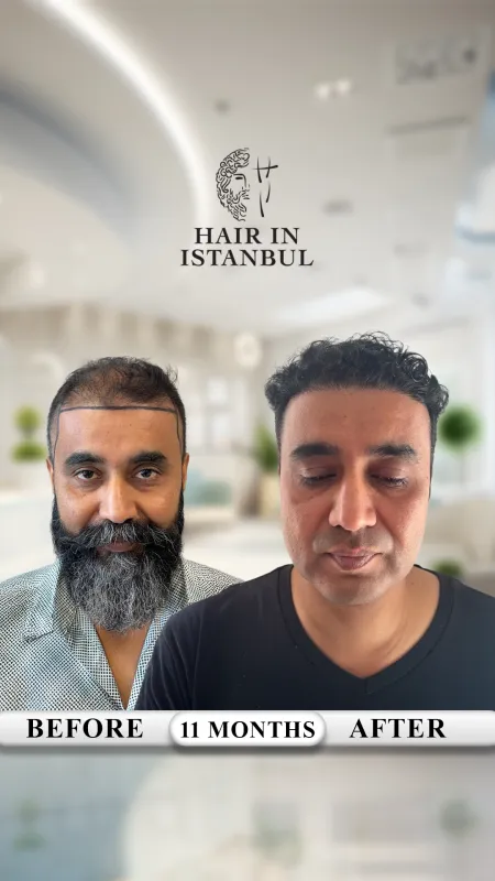Hair transplant before and after · Hair in Istanbul, Istanbul