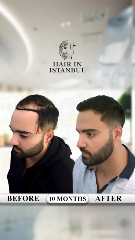 Hair transplant before and after · Hair in Istanbul, Istanbul