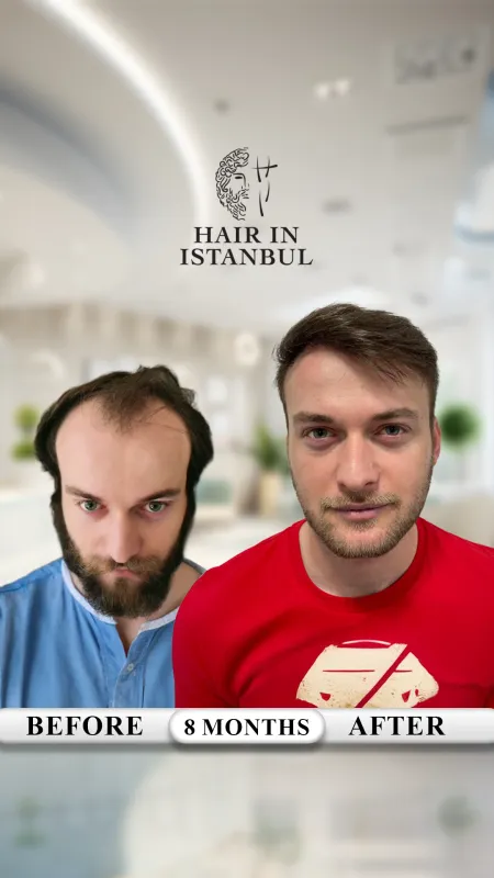 Hair transplant before and after · Hair in Istanbul, Istanbul