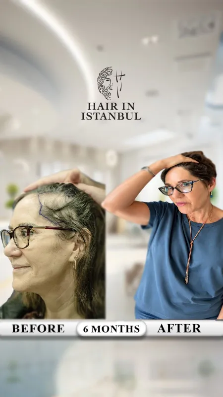 Hair transplant before and after · Hair in Istanbul, Istanbul