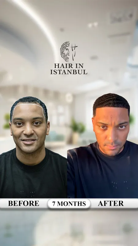 Hair transplant before and after · Hair in Istanbul, Istanbul