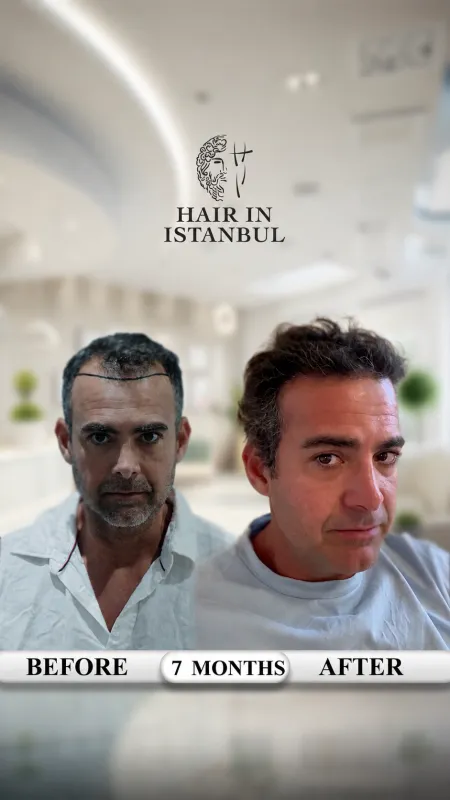 Hair transplant before and after · Hair in Istanbul, Istanbul
