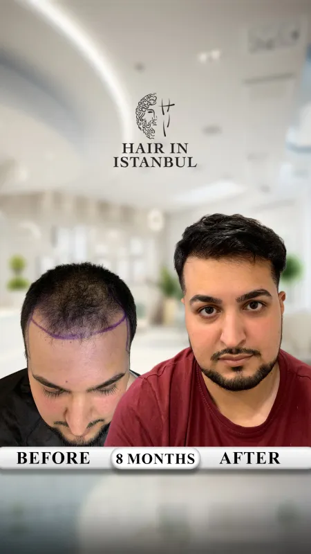 Hair transplant before and after · Hair in Istanbul, Istanbul