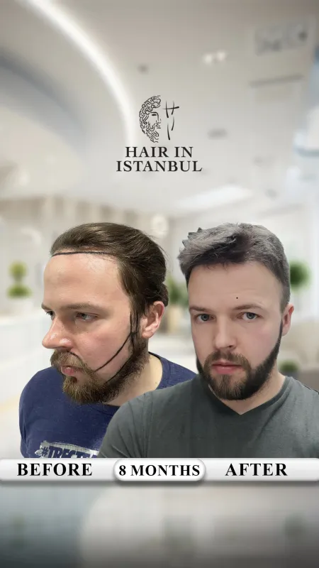 Hair transplant before and after · Hair in Istanbul, Istanbul