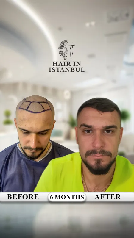 Hair transplant before and after · Hair in Istanbul, Istanbul