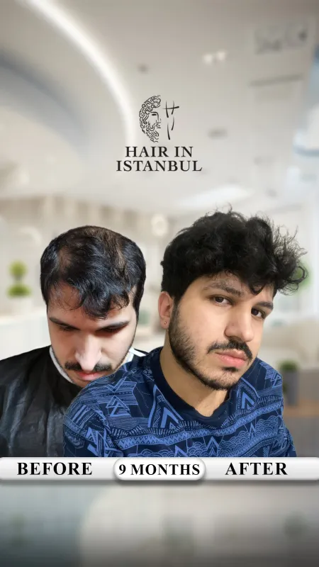Hair transplant before and after · Hair in Istanbul, Istanbul