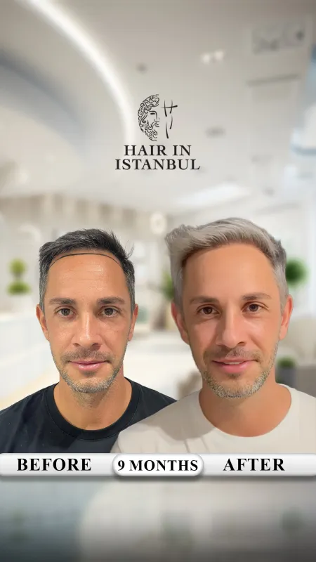 Hair transplant before and after · Hair in Istanbul, Istanbul
