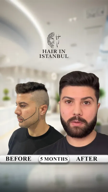 Hair transplant before and after · Hair in Istanbul, Istanbul