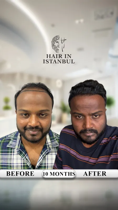 Hair transplant before and after · Hair in Istanbul, Istanbul