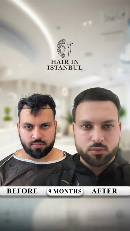 Hair transplant before and after · Hair in Istanbul, Istanbul