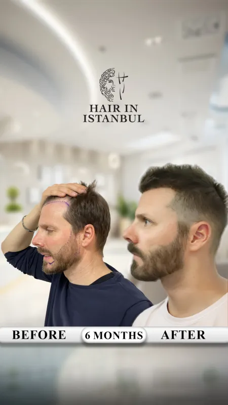 Hair transplant before and after · Hair in Istanbul, Istanbul