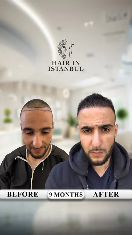 Hair transplant before and after · Hair in Istanbul, Istanbul
