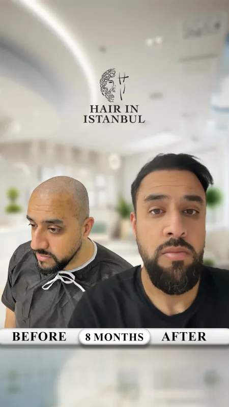 Hair transplant before and after · Hair in Istanbul, Istanbul