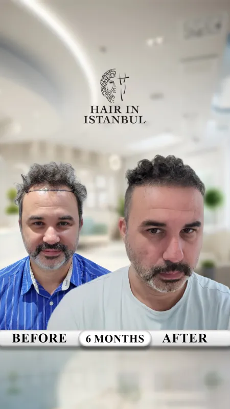 Hair transplant before and after · Hair in Istanbul, Istanbul